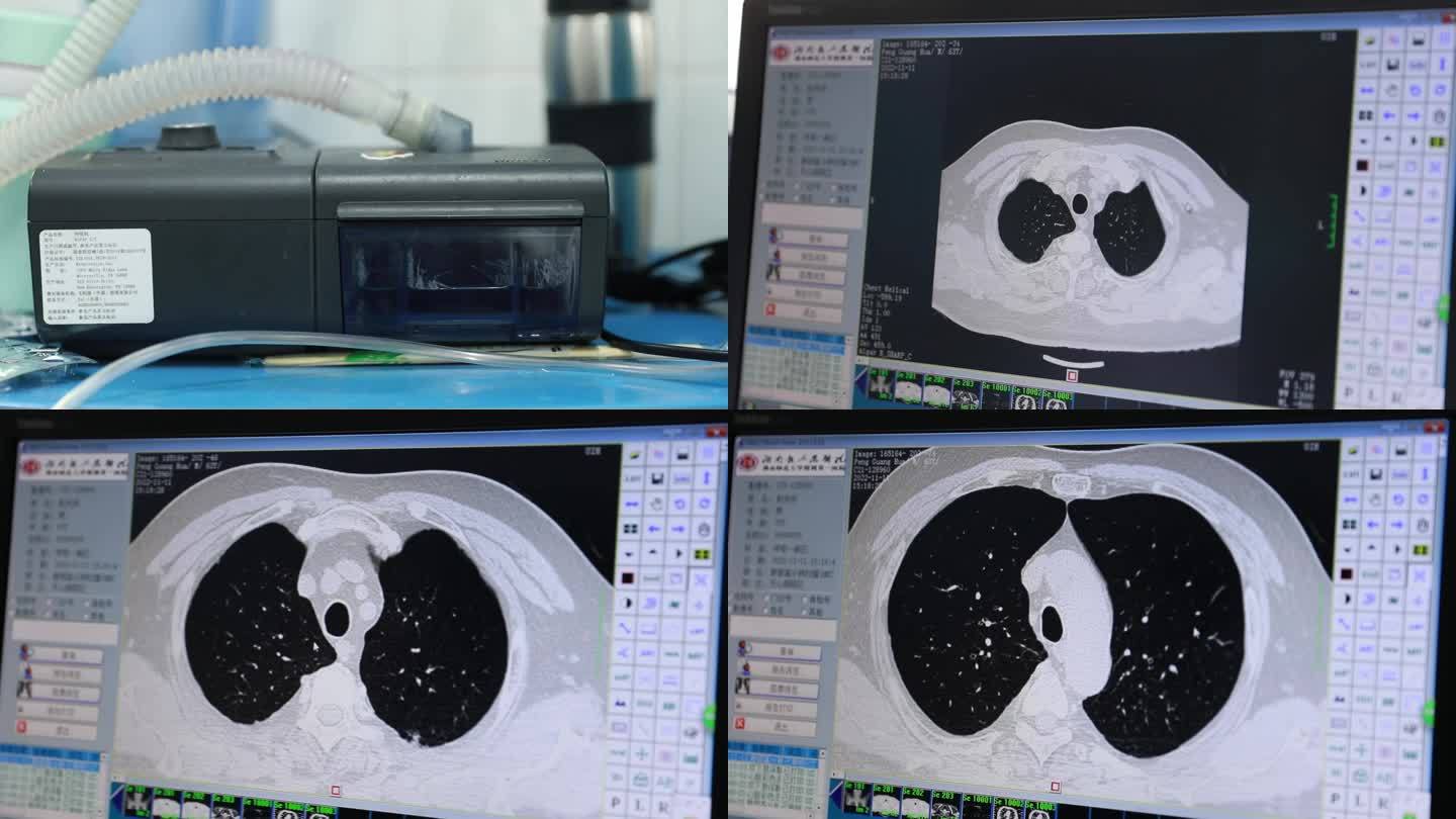 【超清】医生观看-肺部CT