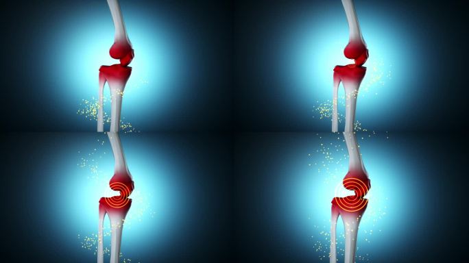 膝盖骨吸收粒子修复损伤3D动画