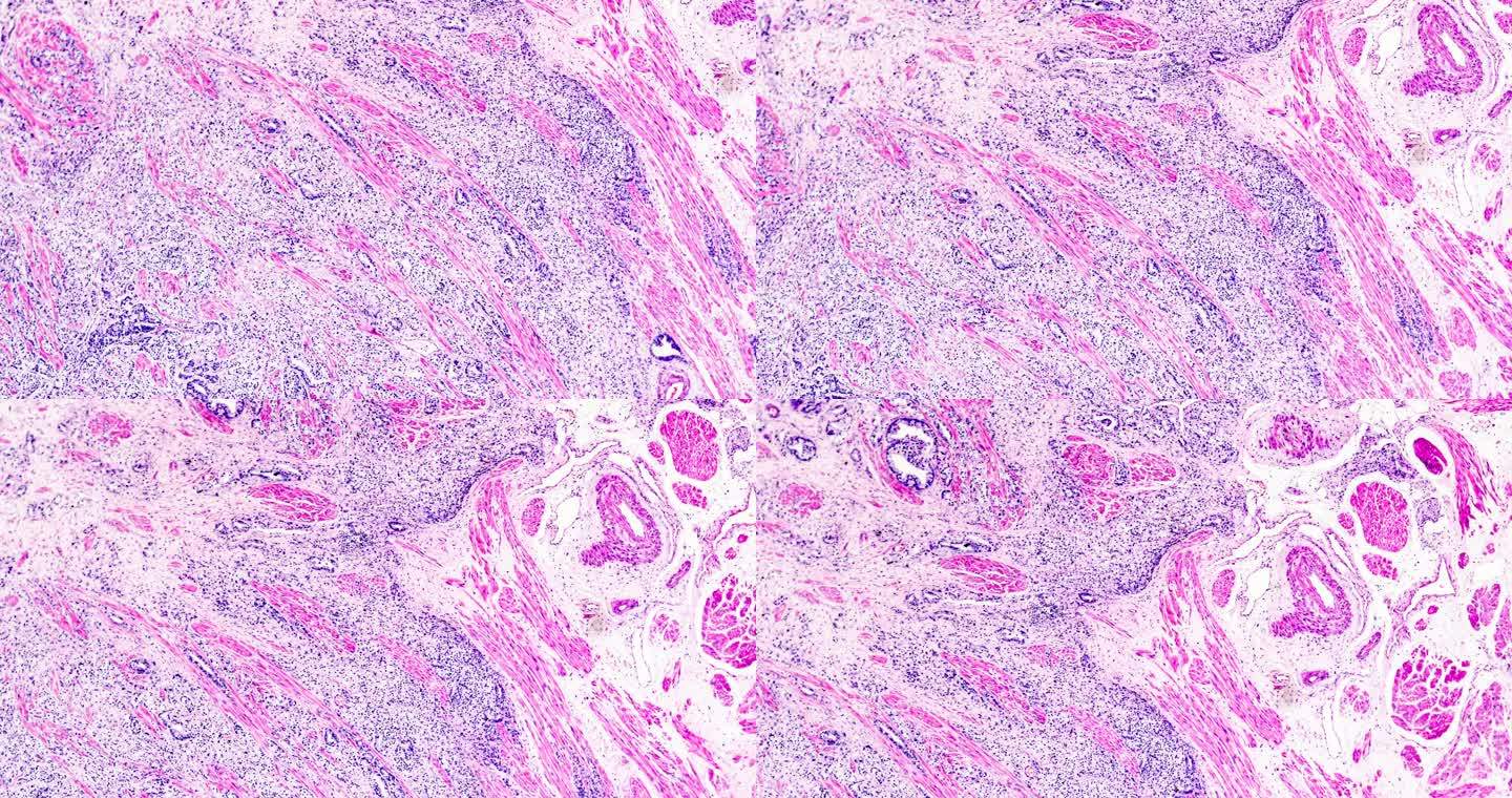 前列腺癌不同区域的显微放大活检