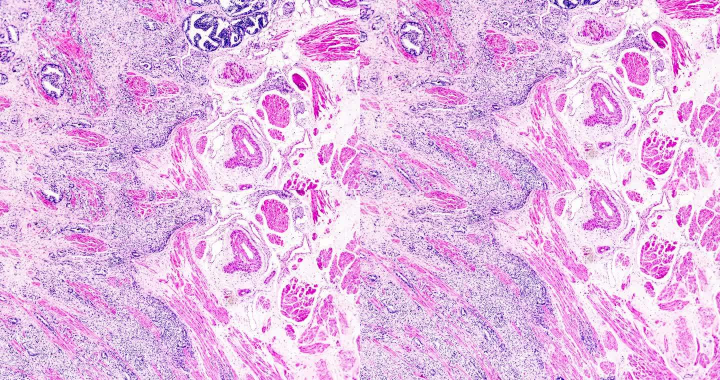 前列腺癌不同区域的显微放大活检