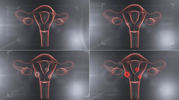 子宫肌瘤三维视频素材