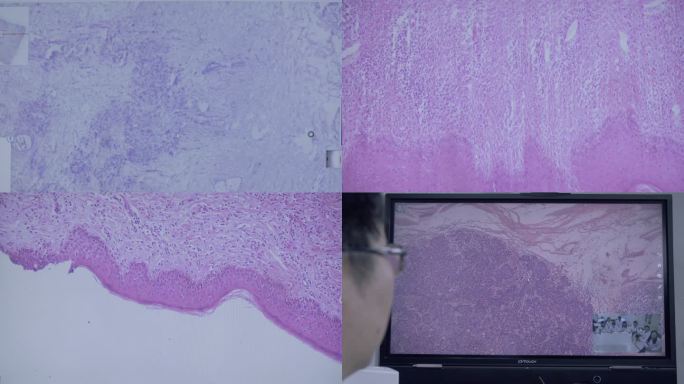 癌症肿瘤显微镜研究