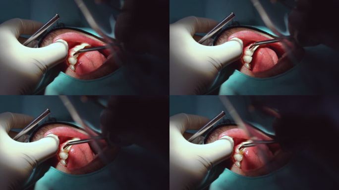 4K慢镜头特写牙科诊所的牙医检查、牙齿清洁和抛光、牙齿护理和牙科检查概念