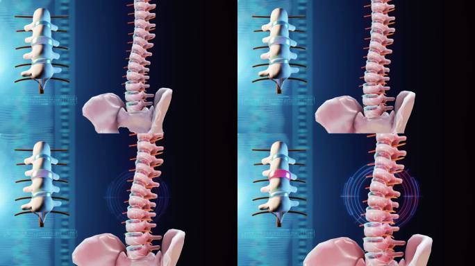 椎间盘突出颈椎病腰间盘突出骨科医院