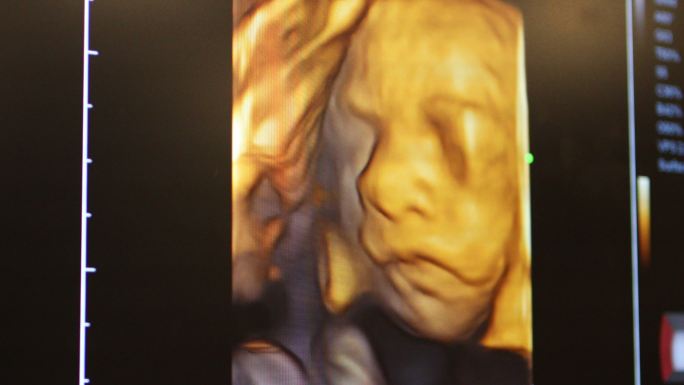 怀孕4D超声彩超影响检测放射科