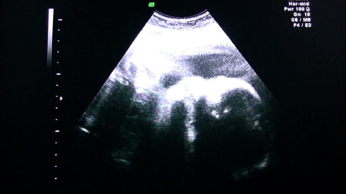超声波B超画面影像视频检查胎儿