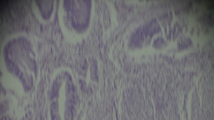 光学显微镜下不同区域的腺肌球蛋白活检