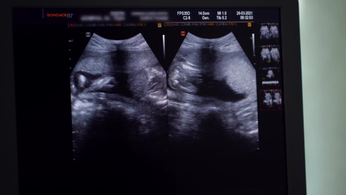 超声检查过程中母亲肚子里的婴儿