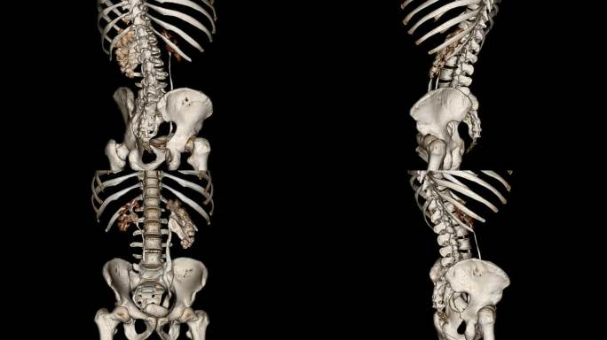 CT肾盂造影CT肾盂造影骨盆人体骨骼模型