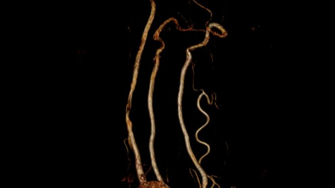 颈动脉CT血管造影