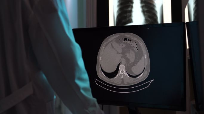 放射科医生在电脑显示器上检查19型冠状病毒CT扫描图像的4K视频