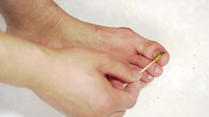 治疗指甲癣灰指甲脚趾甲脚趾消毒