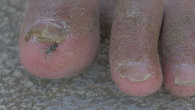 脚灰指甲皮肤干燥龟裂
