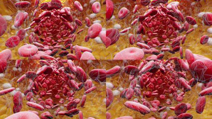 动脉粥样硬化动脉硬化红细胞血管三维动画