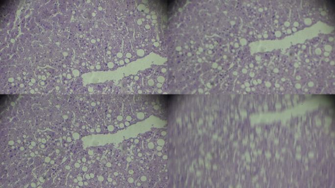 显微镜下肝脏脂肪变性视图，显示圆形脂肪沉积