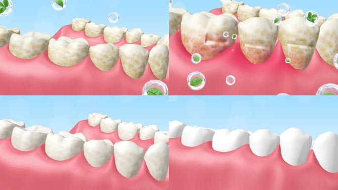 牙齿清洁