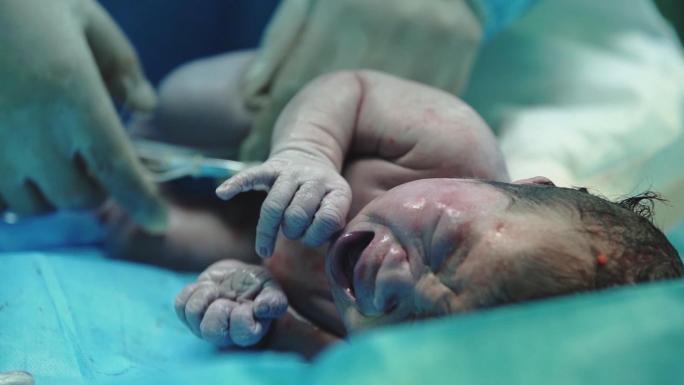 婴儿诞生 剖宫产手术