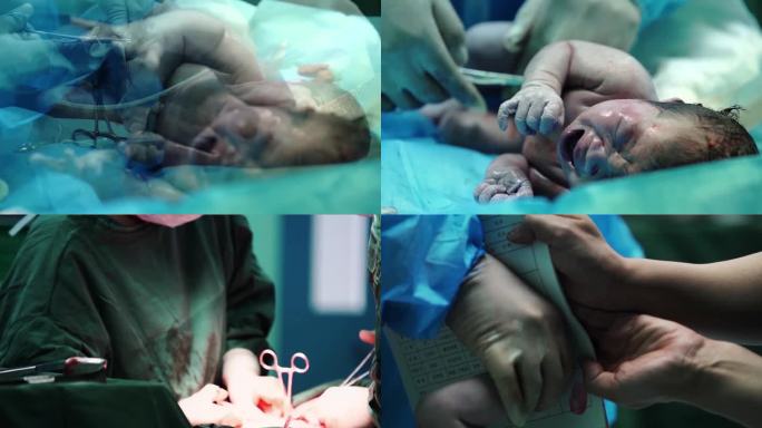 婴儿诞生 剖宫产手术