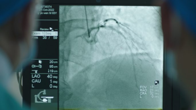 血管手术 血管支架手术 手术 医术 心梗