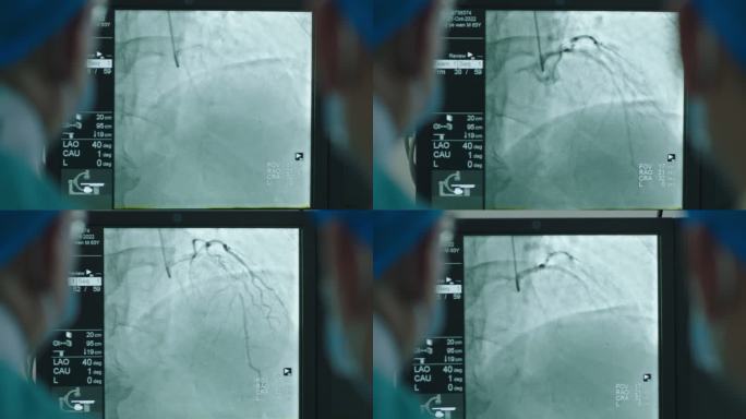 血管手术 血管支架手术 手术 医术 心梗