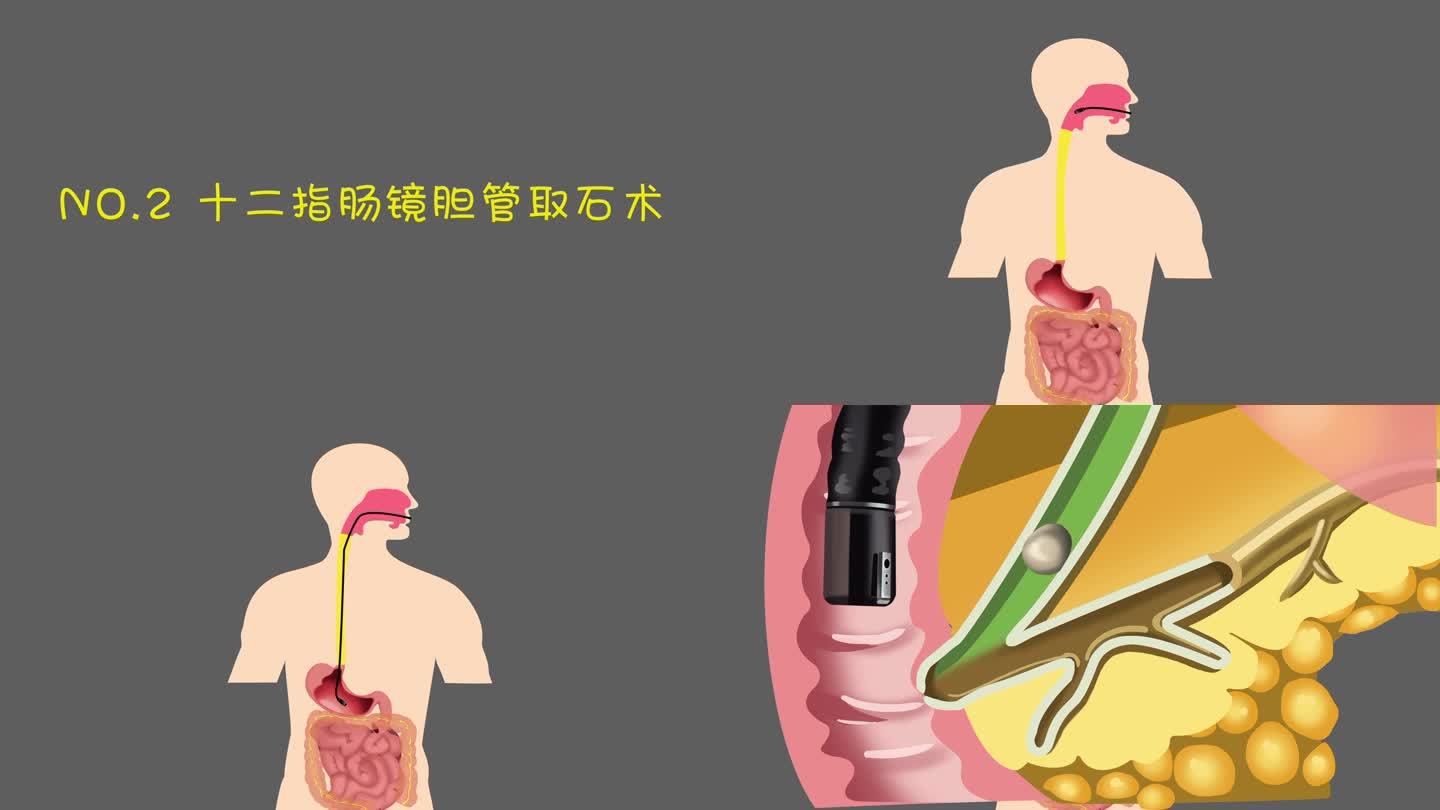经口腔内窥镜手术mg动画介绍