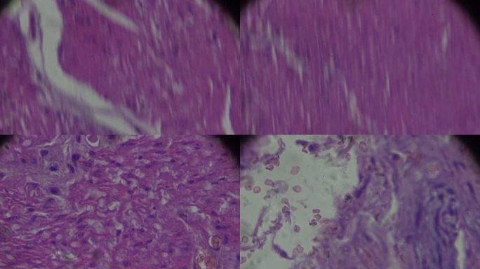 胃腺癌（分化良好的管状腺癌）在光学显微镜下放大不同区域