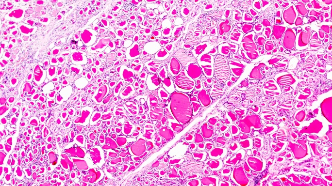 显微镜下的单纯性甲状腺肿，光镜下的不同区域
