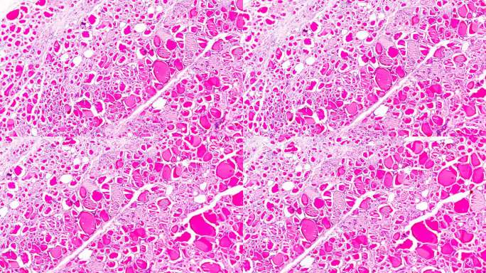 显微镜下的单纯性甲状腺肿，光镜下的不同区域