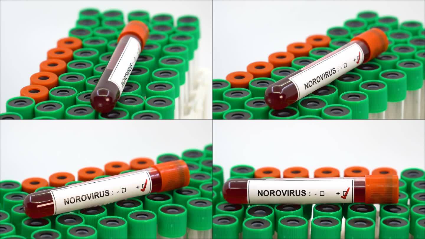 诺如病毒阳性血管核酸检测试管特写新冠疫情