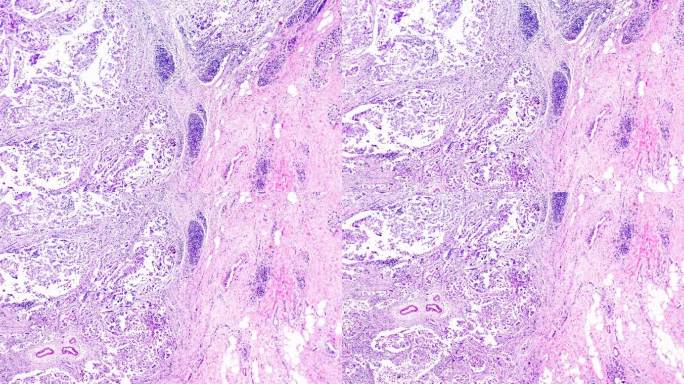 乳腺腺纤维瘤在光学显微镜下不同区域的放大