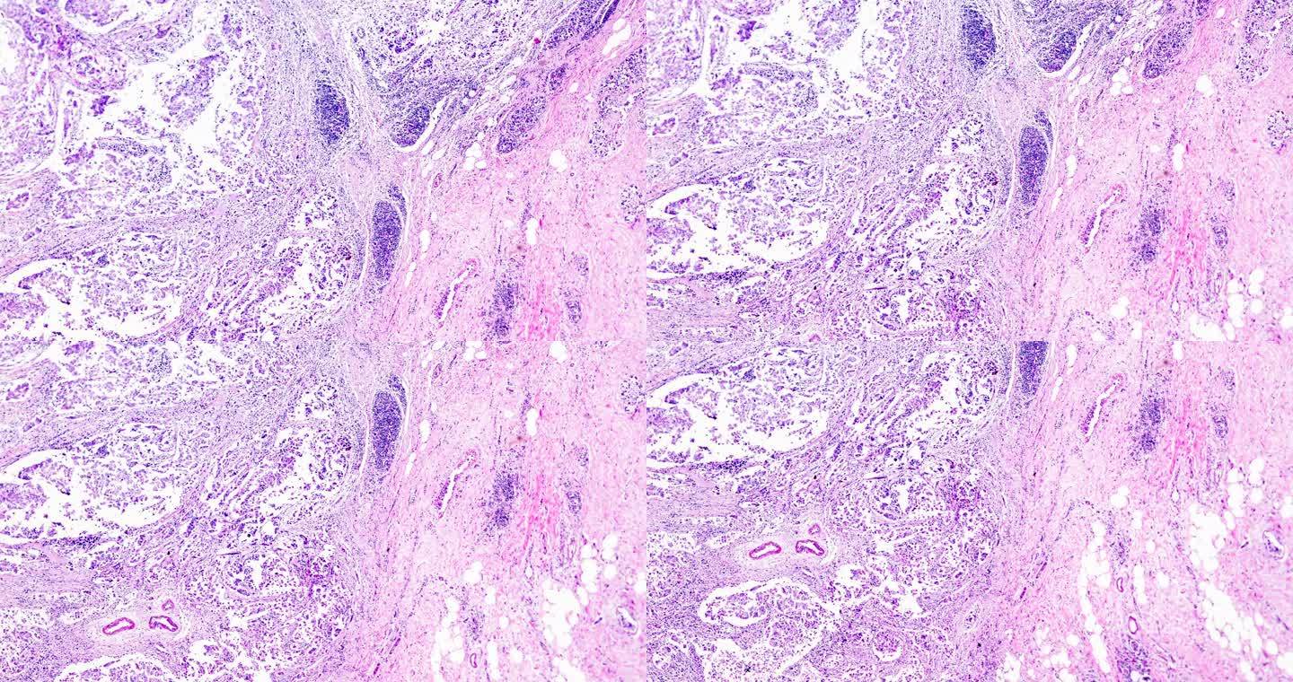 乳腺腺纤维瘤在光学显微镜下不同区域的放大