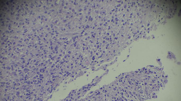 光镜下睾丸生殖细胞瘤