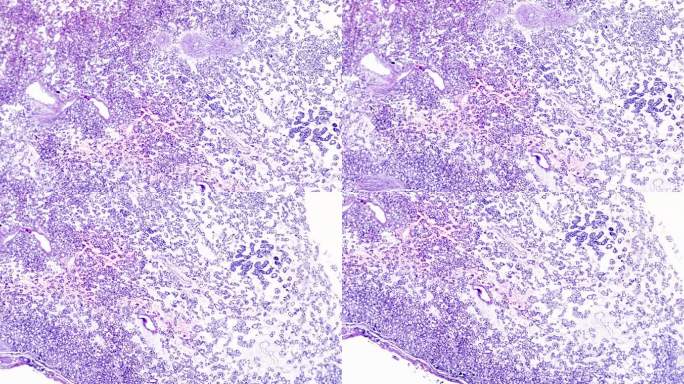 甲状腺癌显微活检显微镜下的细胞