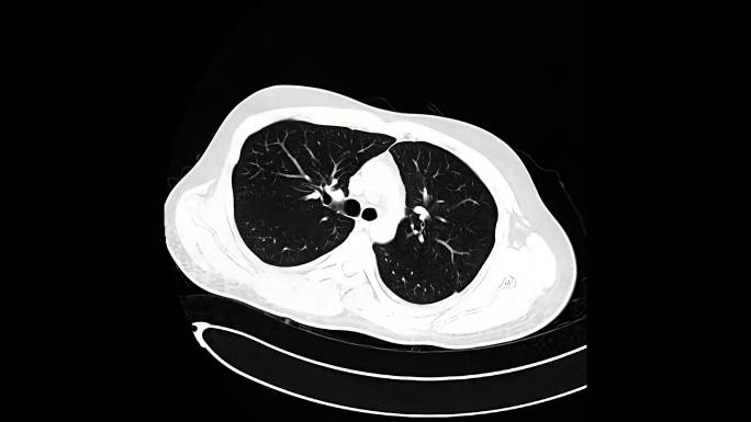 CT扫描胸部检查医院X光透视