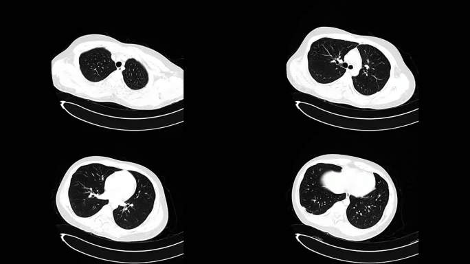 CT扫描胸部检查医院X光透视