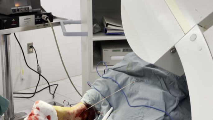 骨科外科医生在背景中使用实时X射线机进行了一项困难的踝关节手术