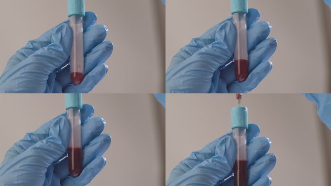 抽血样本用于血液检测实验室的血液检测