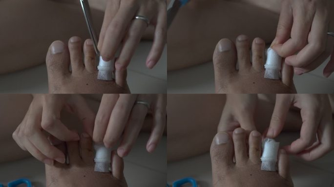 足部手术创伤后的清洁和包扎程序