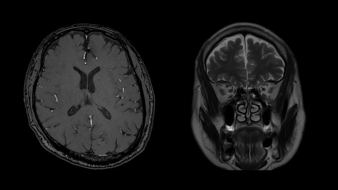 磁共振成像（MRI）的CT脑部扫描图像