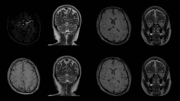 磁共振成像（MRI）的CT脑部扫描图像