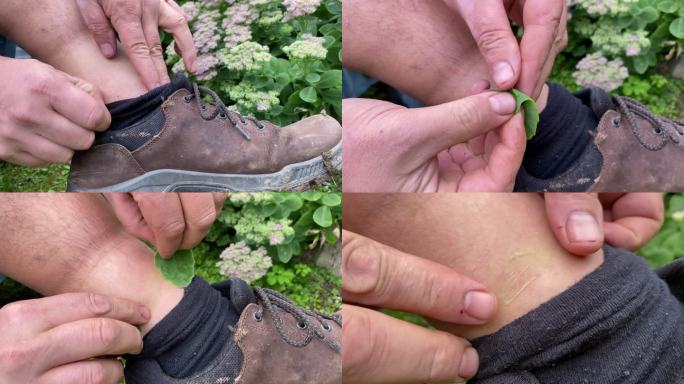 徒步旅行者用莎草叶用天然药物治疗瘙痒的蜱虫叮咬