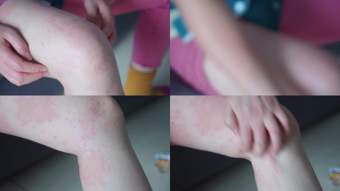 荨麻疹-湿疹-皮肤过敏