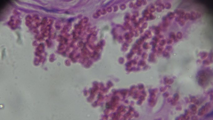 显微镜下人体各种炎症细胞病理标本