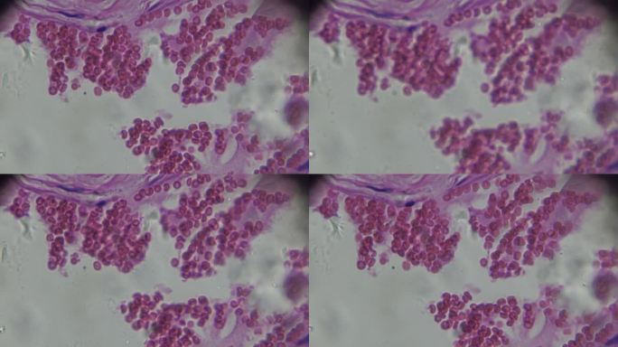 显微镜下人体各种炎症细胞病理标本