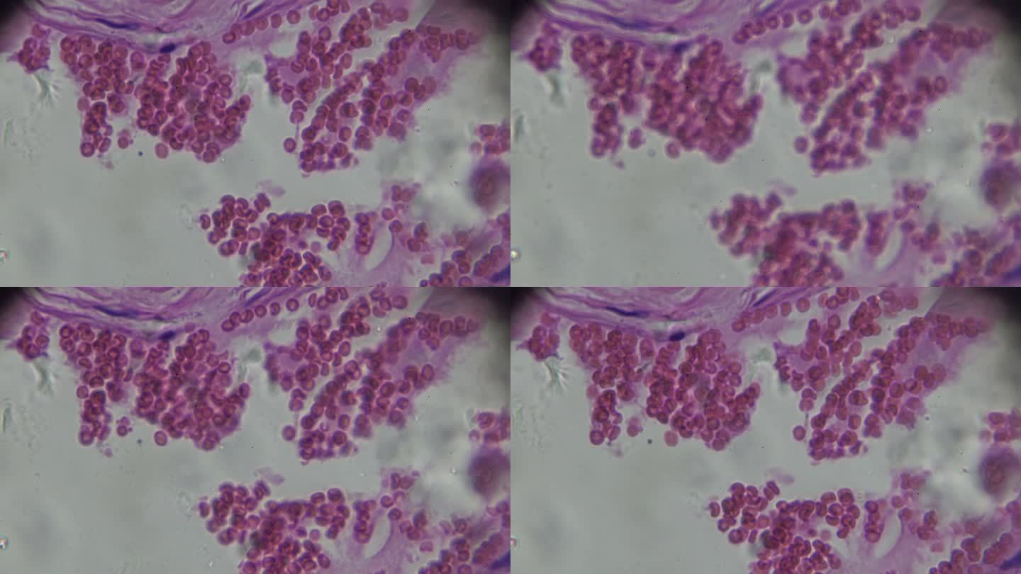 显微镜下人体各种炎症细胞病理标本