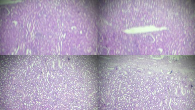 显微镜下肾脏病理标本的压迫性萎缩