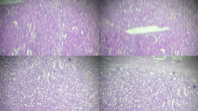 显微镜下肾脏病理标本的压迫性萎缩