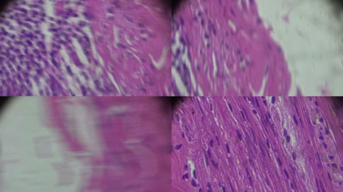 光学显微镜下的慢性阑尾炎病理学