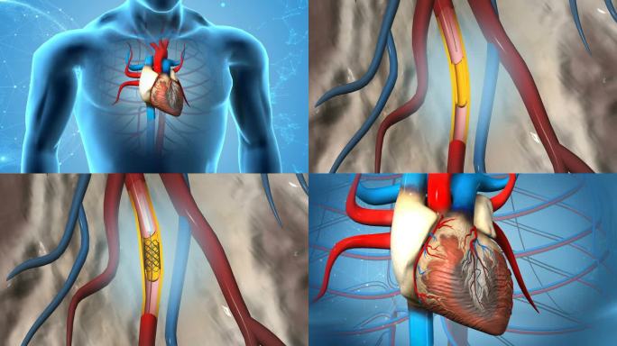 心脏支架