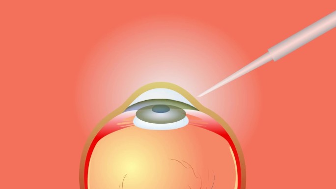 白内障手术动画演示
